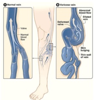 varicose veins laser treatment in Mumbai, varicose veins treatment in mumbai, laser treatment for varicose veins