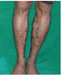 varicose veins laser treatment in dubai, varicose veins treatment in dubai, laser treatment for varicose veins in dubai