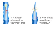 varicose veins laser treatment in dubai, varicose veins treatment in dubai, laser treatment for varicose veins in dubai