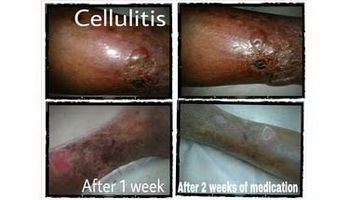 Cellulitis