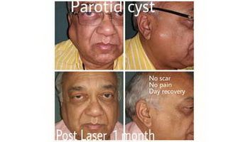 Parotid-Cyst