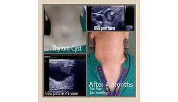 Thyroid-Cyst