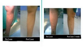 piles laser treatment in mumbai, laser treatment for fistula, laser treatment for piles, laser treatment for varicose veins, piles treatment in mumbai, varicose veins laser treatment in mumbai