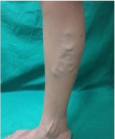 varicose veins laser treatment in dubai, varicose veins treatment in dubai, laser treatment for varicose veins in dubai