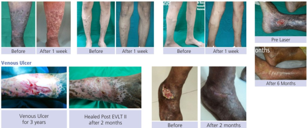 varicose veins laser treatment in mumbai, laser treatment for varicose veins