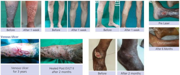 varicose veins laser treatment in dubai, varicose veins treatment in dubai, laser treatment for varicose veins in dubai