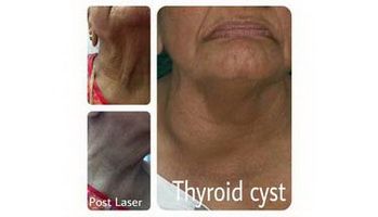 Thyroid-Cyst